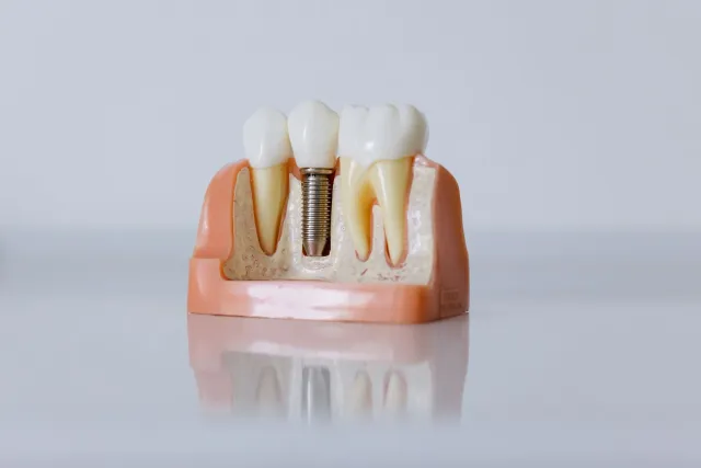 Ema ida ho implante dentáriu halo check-up iha dentista, ho sorrisu saudável no dentes moos